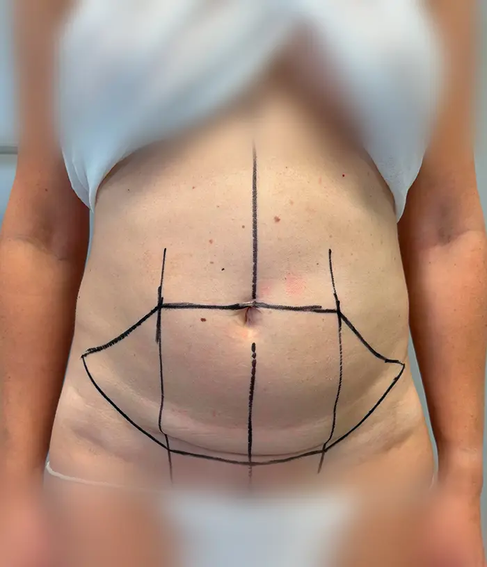 Tors z chirurgicznymi oznaczeniami na brzuchu, osoba ubrana w biały top.