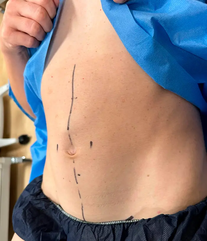 Brzuch osoby z chirurgicznymi oznaczeniami narysowanymi czarnym tuszem w pobliżu pępka.