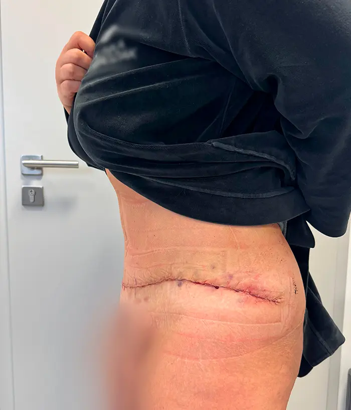 Osoba podnosząca koszulę, aby odsłonić gojącą się bliznę chirurgiczną na podbrzuszu, stojąca w otoczeniu medycznym.