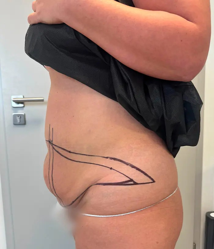 Tors osoby z oznaczeniami chirurgicznymi w dolnej części brzucha, prawdopodobnie po zabiegu kosmetycznym lub medycznym.