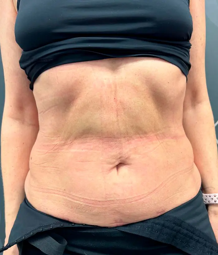 Zbliżenie kobiecego brzucha ukazujące luźną skórę i rozstępy, ubraną w sportowy stanik i spodnie.