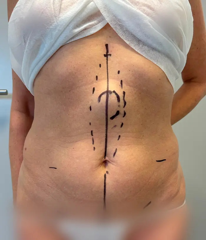 Tors z chirurgicznymi oznaczeniami na brzuchu, osoba ubrana w białą szmatkę owiniętą wokół klatki piersiowej.