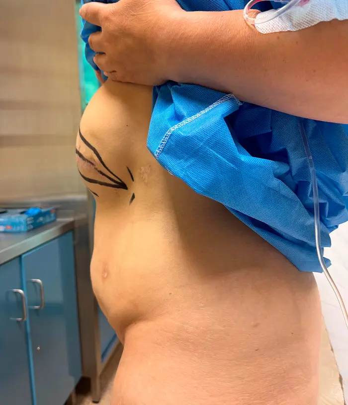 Osoba w otoczeniu medycznym z oznaczeniami chirurgicznymi na brzuchu, podnosząca niebieski fartuch, aby pokazać obszar.