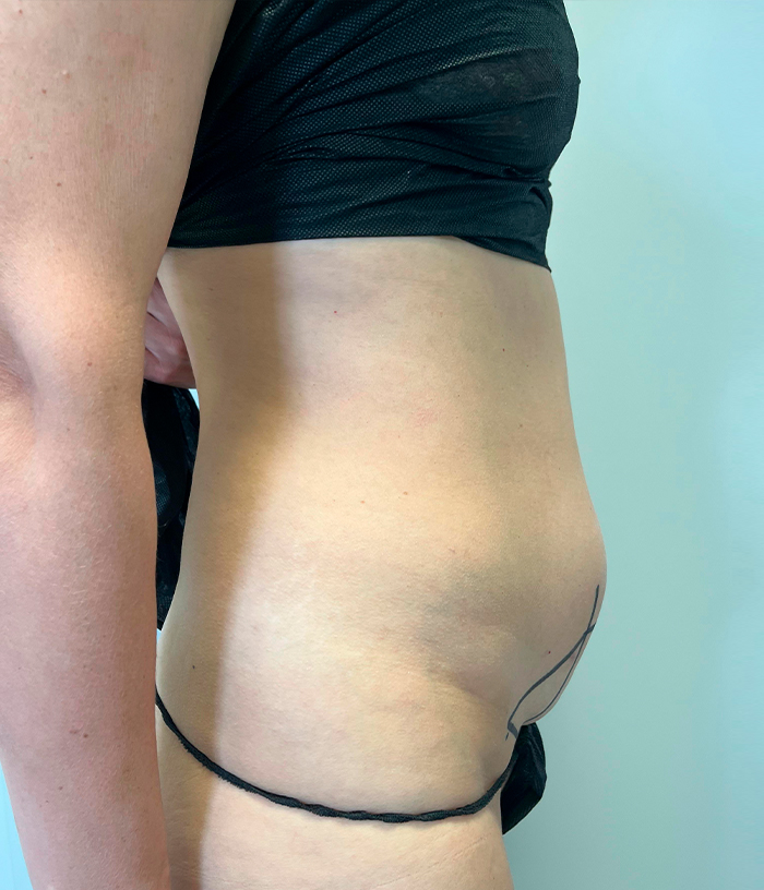 Przepuklina pooperacyjna w podbrzuszu + plastyka podbrzusza - przed zabiegiem